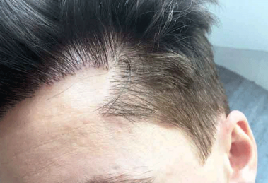 fue hair transplant