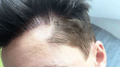 fue hair transplant