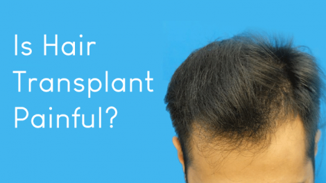 Is Hair Transplant Painful